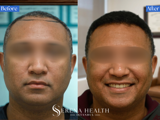 Close-up view of the DHI hair transplant technique showing precise follicle placement in curly hair.