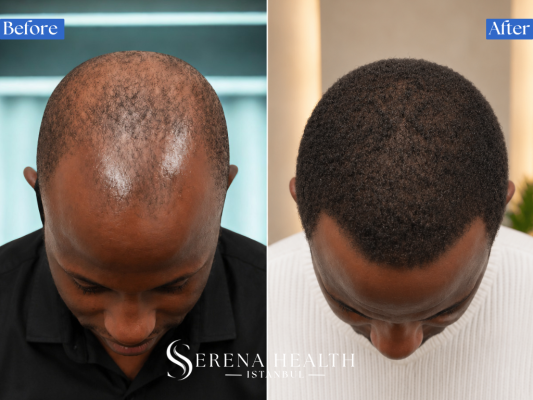 Close-up of a successful crown hair transplant for a patient with curly afro hair.